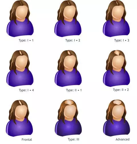 determine the extent hair loss stages