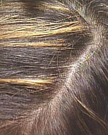 02 after solutions neutral gallery hairmax 02 after