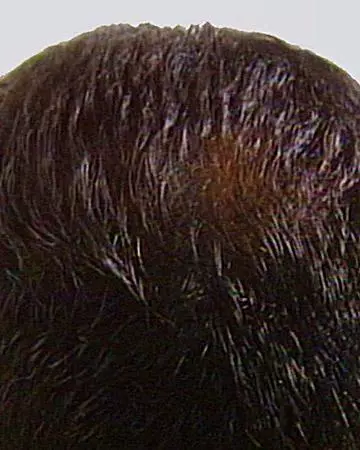 03 after solutions neutral gallery hairmax 03 after