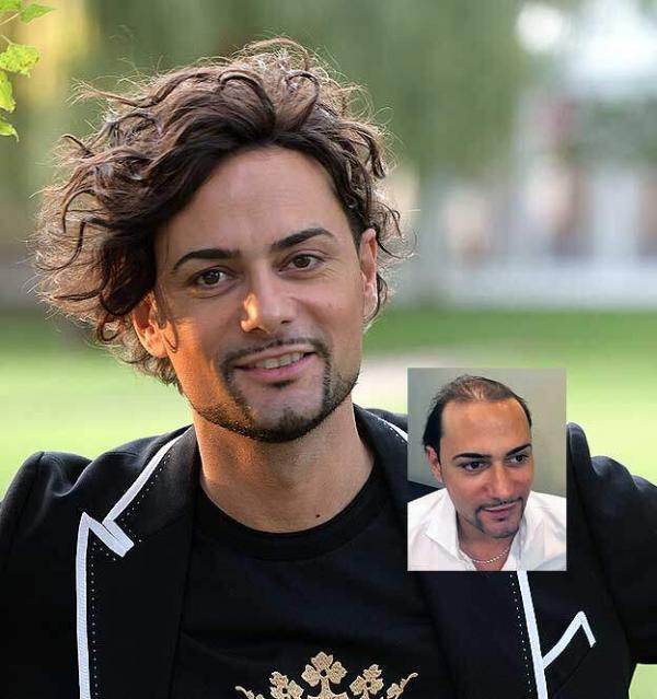 Mens Non-Surgical Hair Replacement Dayton OH Mens Non-Surgical Hair Replacement Dayton OH