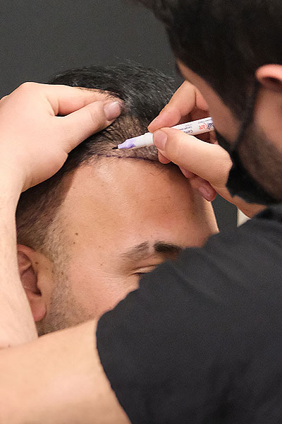 hair-tranplant-specialist-clinic-dayton-cincinnati-lexington hair tranplant specialist clinic dayton cincinnati lexington