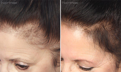 hairmax laser results at home laser hair loss treatment results female