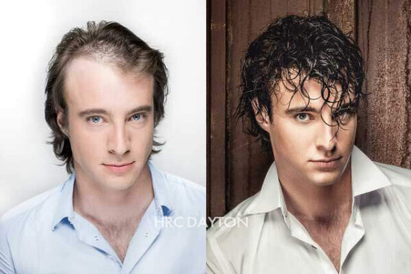 HRC Dayton Mens Hair Replacement