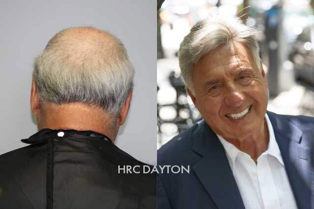 HRC Dayton Mens Hair Replacement