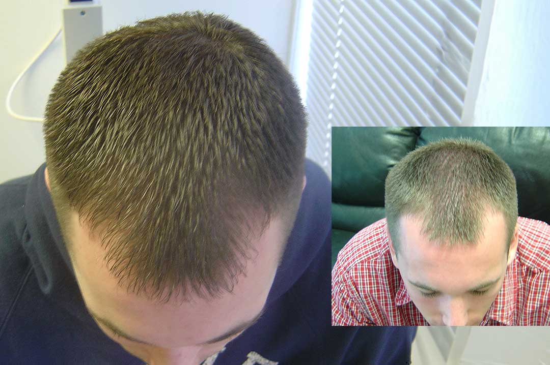 laser hair loss rejuvenation treatment dayton ohio laser hair loss treatment results male