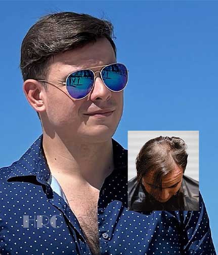 mens-custom-hair-replacement-dayton-montgomery-county-ohio mens custom hair replacement dayton montgomery county ohio